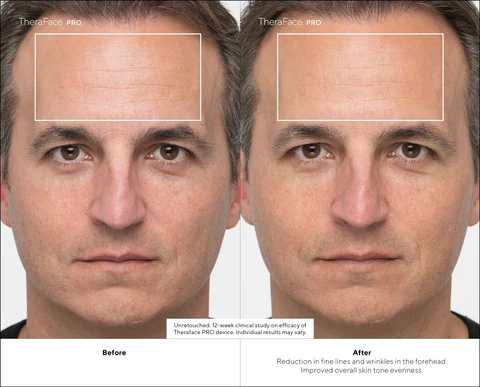 TheraFace Before and After