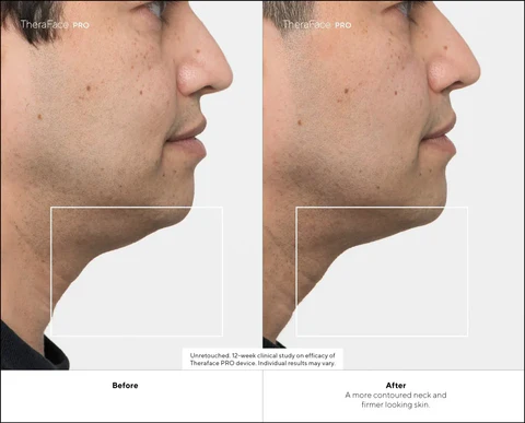 TheraFace PRO Skin Results